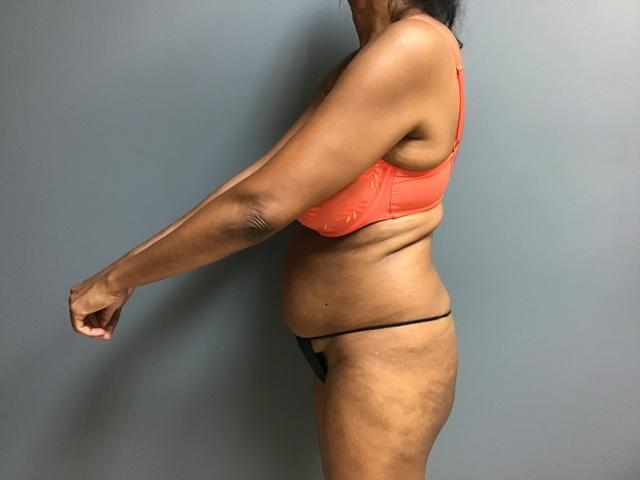 Brazilian Butt Lift before at Aesthetic Plastic Surgery & Laser Center, Michelle Hardaway M.D. in Farmington Hills, MI