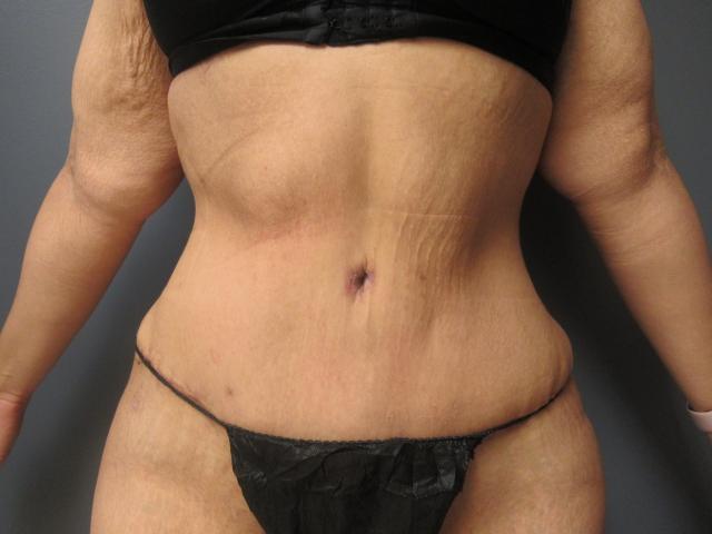 Liposuction after at Aesthetic Plastic Surgery & Laser Center, Michelle Hardaway M.D. in Farmington Hills, MI