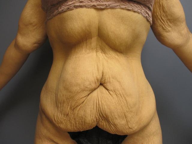 Liposuction before at Aesthetic Plastic Surgery & Laser Center, Michelle Hardaway M.D. in Farmington Hills, MI