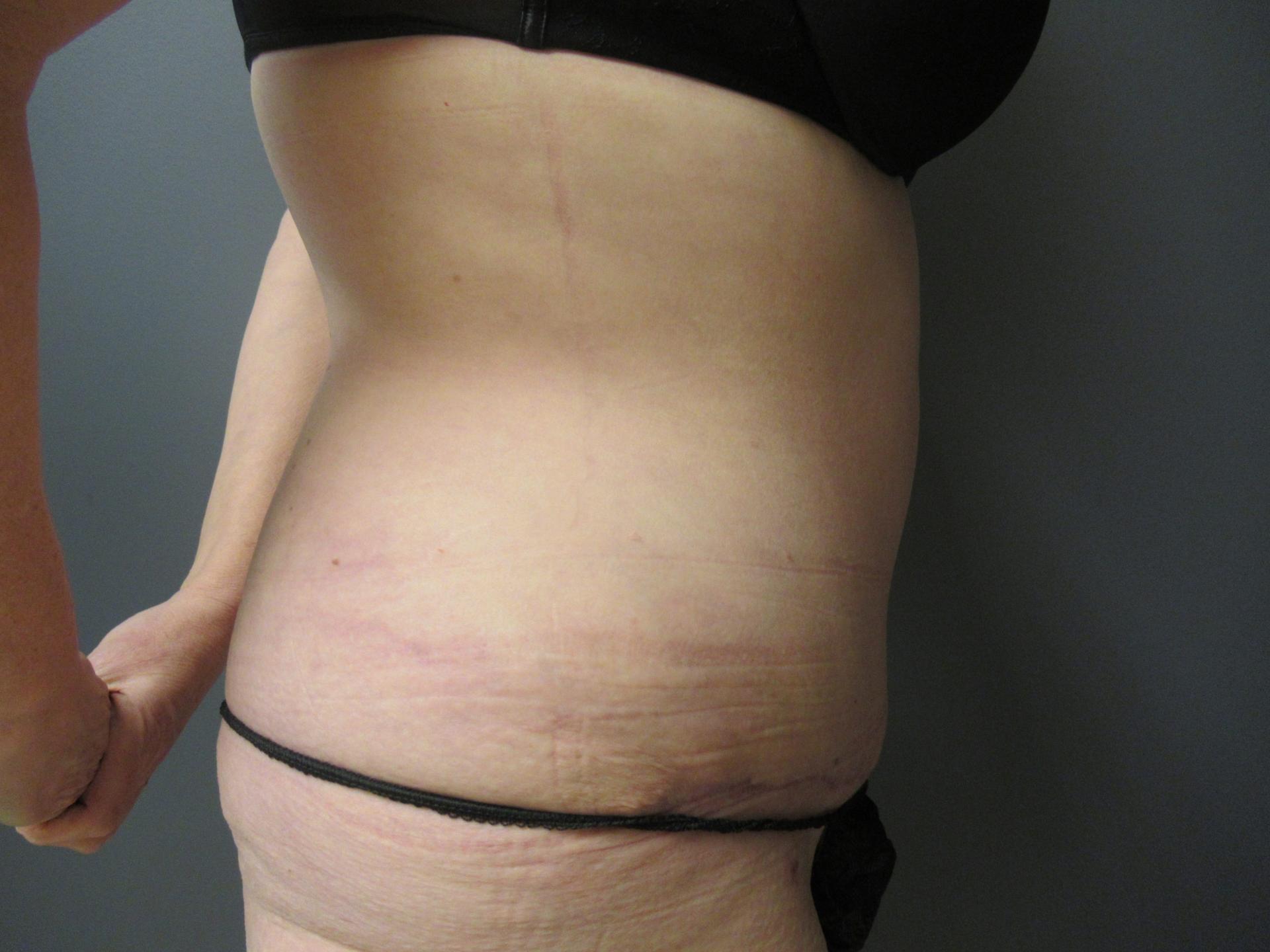 Aesthetic Plastic Surgery & Laser Center, Michelle Hardaway M.D. tummy tuck after — Farmington Hills, MI