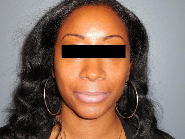 Rhinoplasty after at Aesthetic Plastic Surgery & Laser Center, Michelle Hardaway M.D. in Farmington Hills, MI