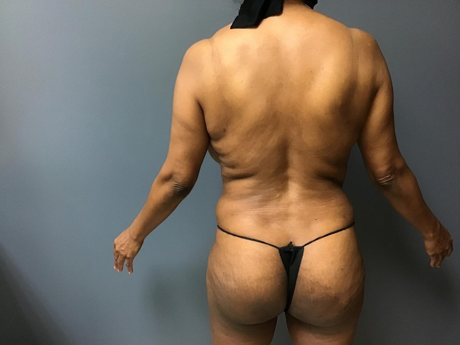 Aesthetic Plastic Surgery & Laser Center, Michelle Hardaway M.D. bbl after — Farmington Hills, MI