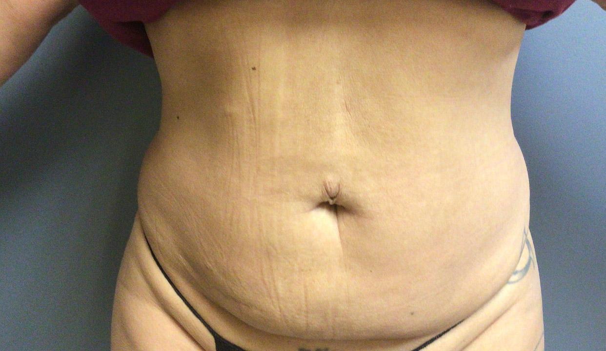 Aesthetic Plastic Surgery & Laser Center, Michelle Hardaway M.D. bbl result — Farmington Hills, MI