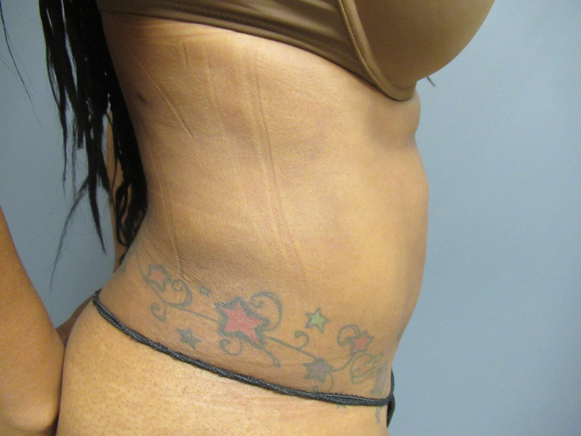 Aesthetic Plastic Surgery & Laser Center, Michelle Hardaway M.D. liposuction after — Farmington Hills, MI