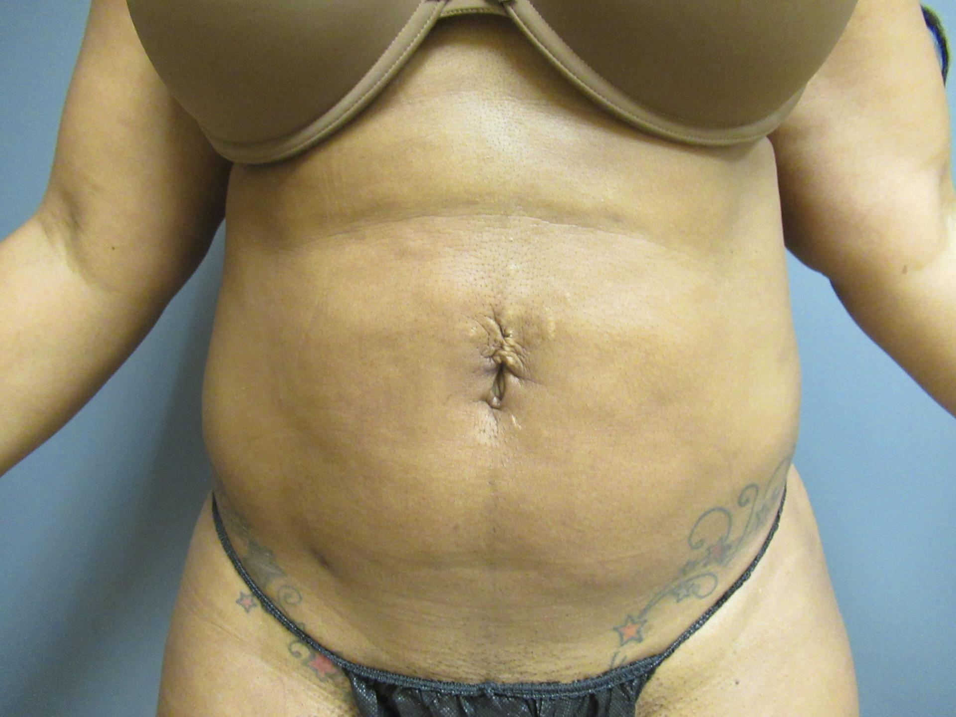 Aesthetic Plastic Surgery & Laser Center, Michelle Hardaway M.D. liposuction after — Farmington Hills, MI