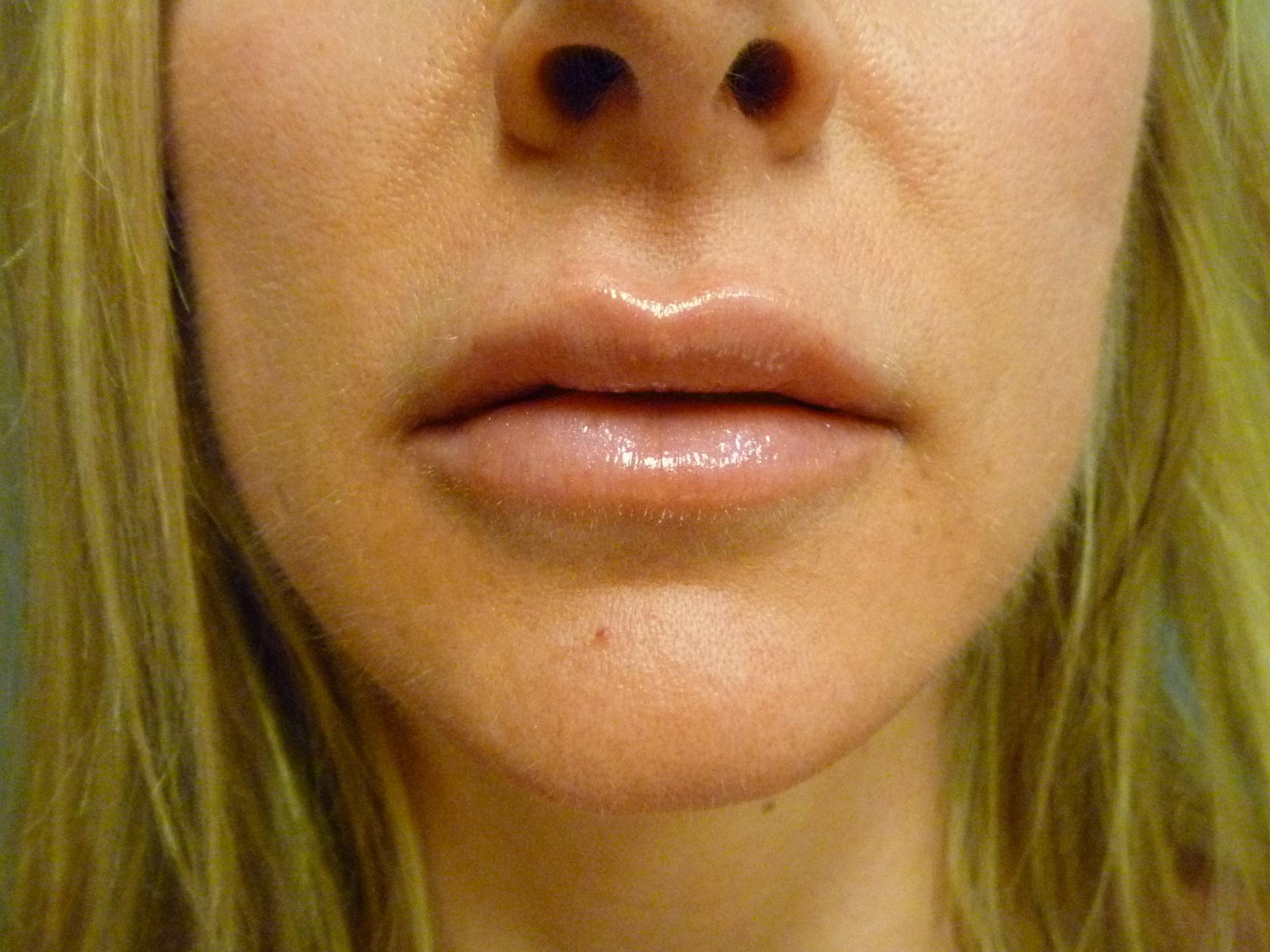 Aesthetic Plastic Surgery & Laser Center, Michelle Hardaway M.D. body contouring after — Farmington Hills, MI