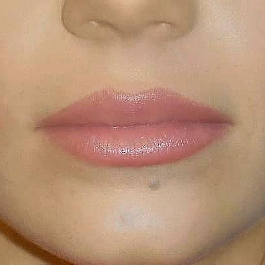 Aesthetic Plastic Surgery & Laser Center, Michelle Hardaway M.D. body contouring after — Farmington Hills, MI
