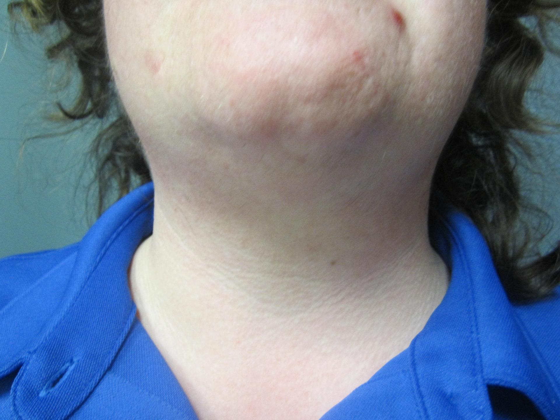 Aesthetic Plastic Surgery & Laser Center, Michelle Hardaway M.D. laser treatment after — Farmington Hills, MI