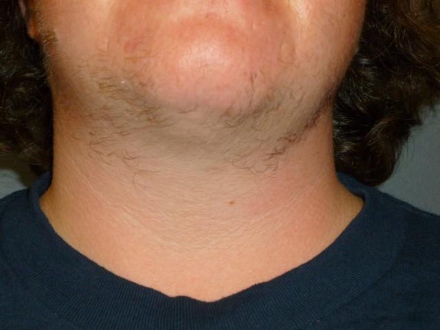 Morpheus8 before at Aesthetic Plastic Surgery & Laser Center, Michelle Hardaway M.D. in Farmington Hills, MI