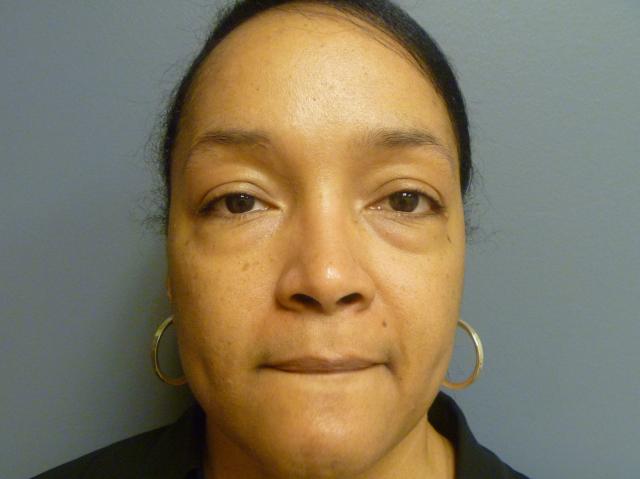 Blepharoplasty before at Aesthetic Plastic Surgery & Laser Center, Michelle Hardaway M.D. in Farmington Hills, MI