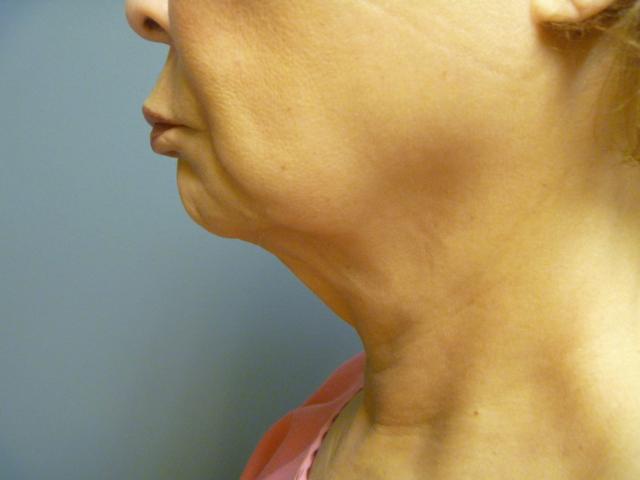 Neck Lift before at Aesthetic Plastic Surgery & Laser Center, Michelle Hardaway M.D. in Farmington Hills, MI