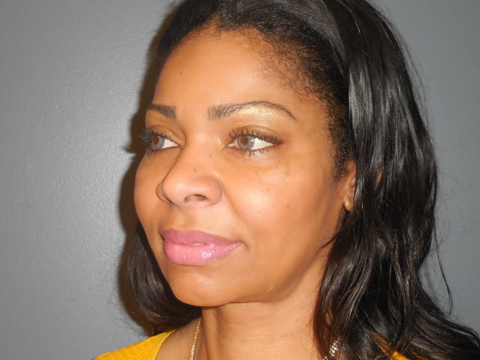 Aesthetic Plastic Surgery & Laser Center, Michelle Hardaway M.D. facelift after — Farmington Hills, MI