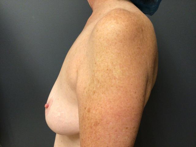 Breast Lift before at Aesthetic Plastic Surgery & Laser Center, Michelle Hardaway M.D. in Farmington Hills, MI