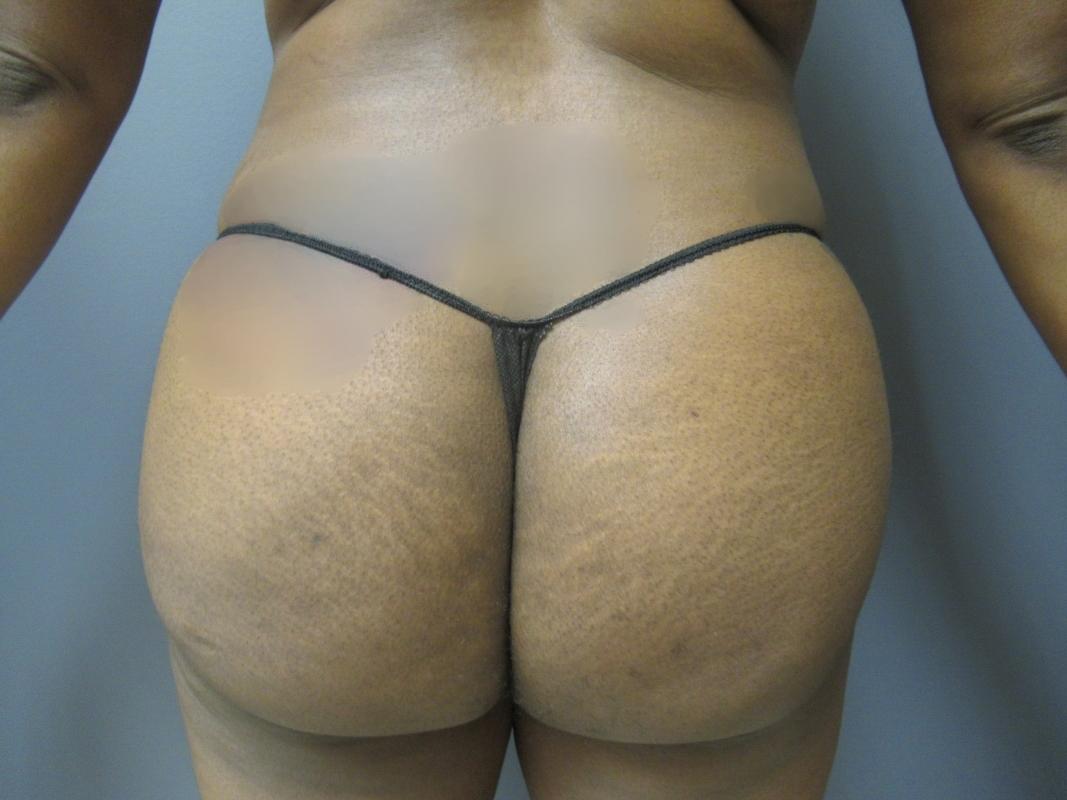 Aesthetic Plastic Surgery & Laser Center, Michelle Hardaway M.D. fat transfer after — Farmington Hills, MI