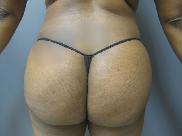 Fat Transfer after at Aesthetic Plastic Surgery & Laser Center, Michelle Hardaway M.D. in Farmington Hills, MI