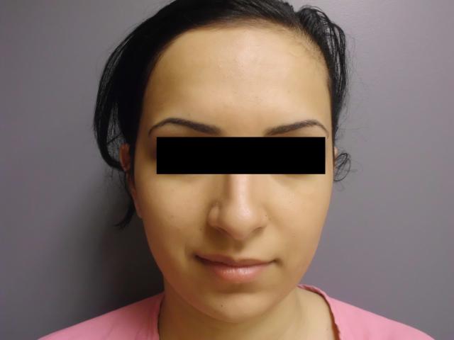 Rhinoplasty before at Aesthetic Plastic Surgery & Laser Center, Michelle Hardaway M.D. in Farmington Hills, MI