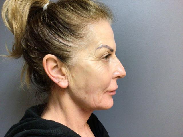 Blepharoplasty after at Aesthetic Plastic Surgery & Laser Center, Michelle Hardaway M.D. in Farmington Hills, MI