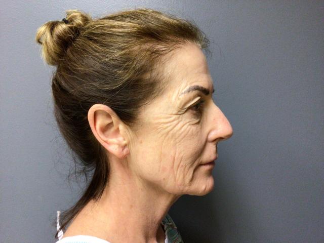 Blepharoplasty before at Aesthetic Plastic Surgery & Laser Center, Michelle Hardaway M.D. in Farmington Hills, MI