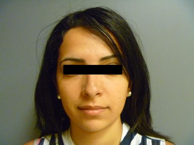Facelift after at Aesthetic Plastic Surgery & Laser Center, Michelle Hardaway M.D. in Farmington Hills, MI