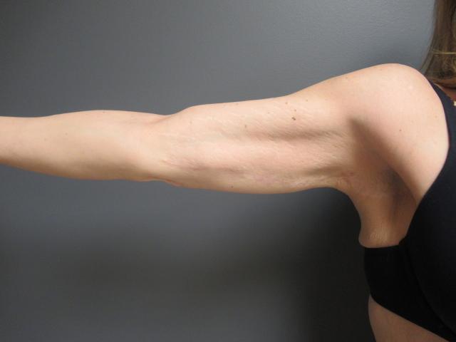 Arm Lift after at Aesthetic Plastic Surgery & Laser Center, Michelle Hardaway M.D. in Farmington Hills, MI