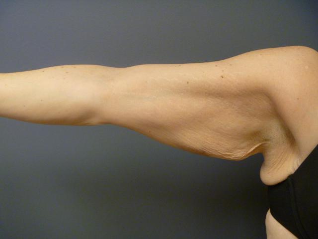Arm Lift before at Aesthetic Plastic Surgery & Laser Center, Michelle Hardaway M.D. in Farmington Hills, MI