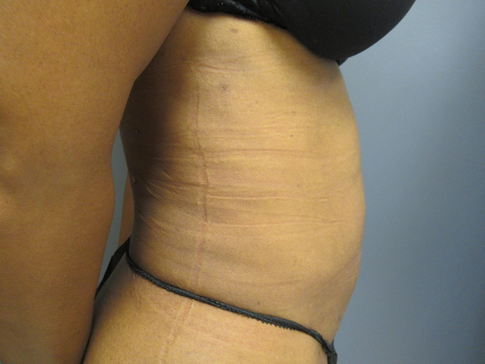 Aesthetic Plastic Surgery & Laser Center, Michelle Hardaway M.D. liposuction after — Farmington Hills, MI