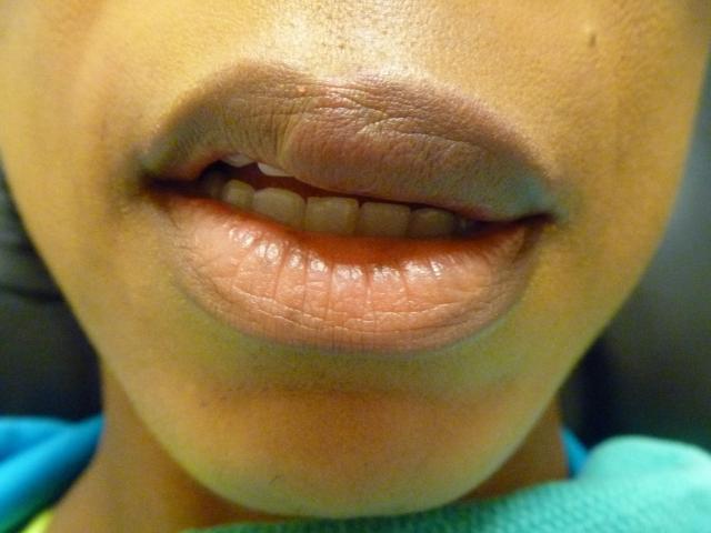 Dermal Fillers before at Aesthetic Plastic Surgery & Laser Center, Michelle Hardaway M.D. in Farmington Hills, MI