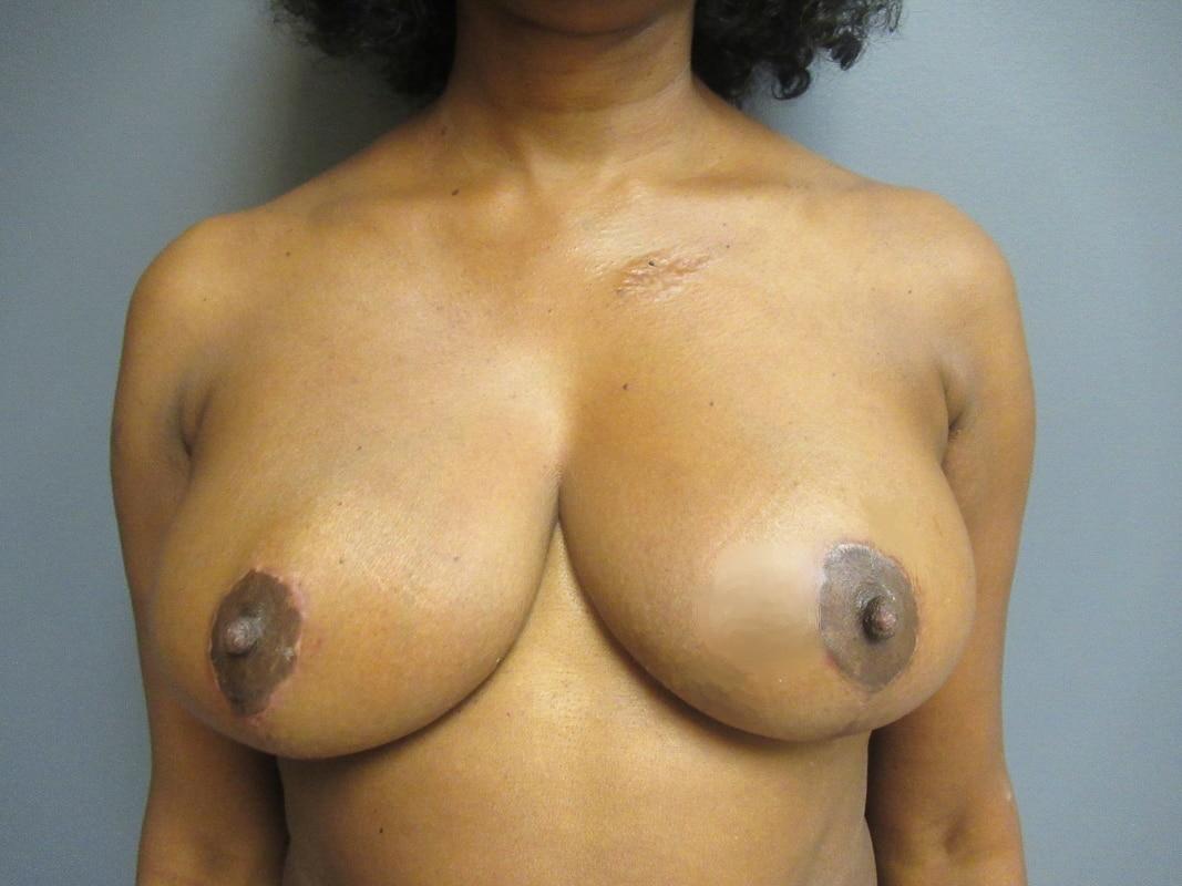 Aesthetic Plastic Surgery & Laser Center, Michelle Hardaway M.D. breast reduction after — Farmington Hills, MI