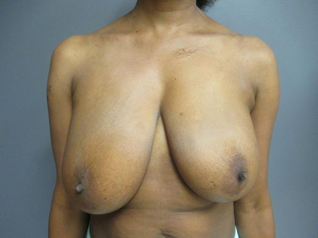 Breast Reduction before at Aesthetic Plastic Surgery & Laser Center, Michelle Hardaway M.D. in Farmington Hills, MI