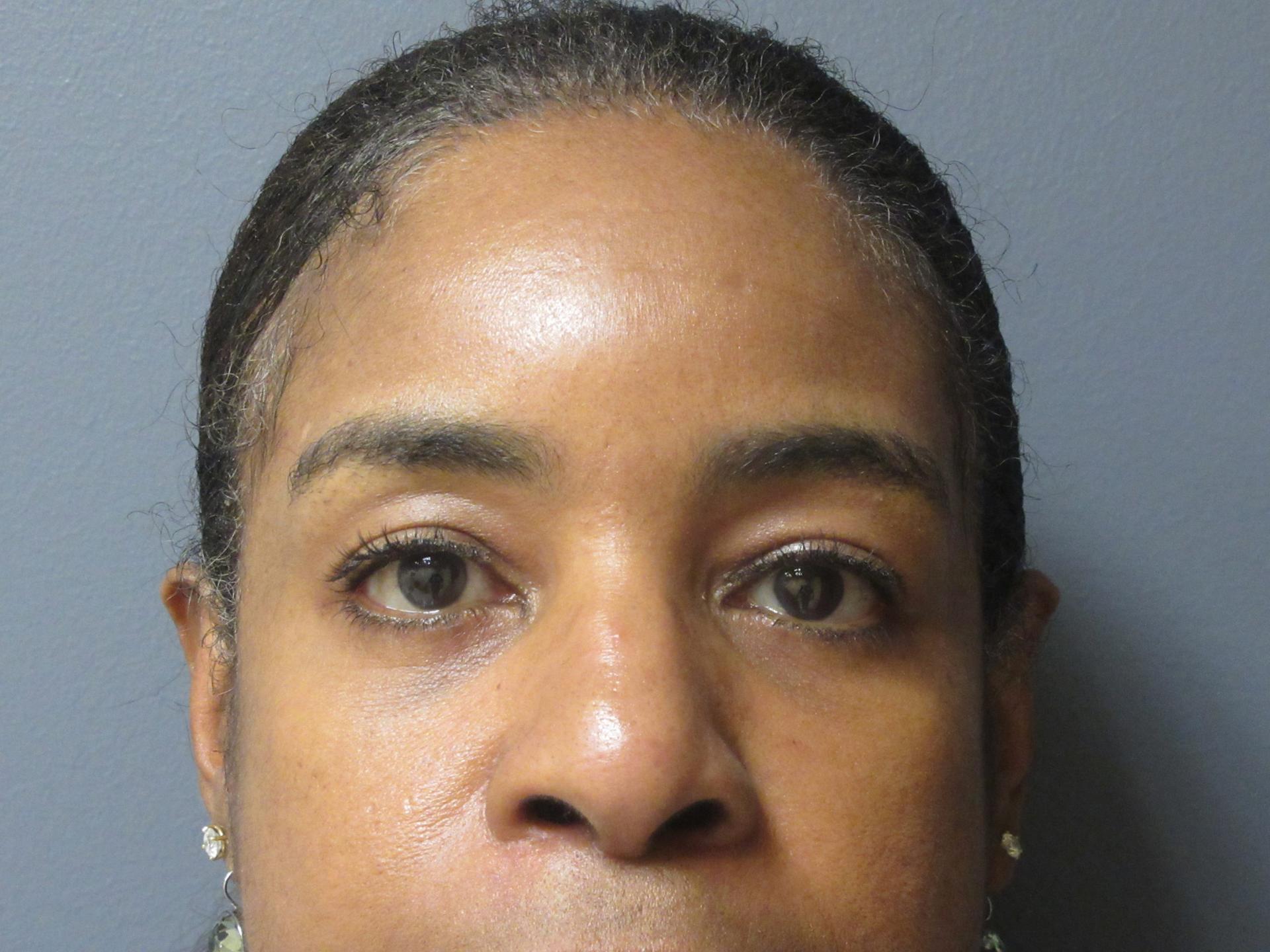 Aesthetic Plastic Surgery & Laser Center, Michelle Hardaway M.D. facelift after — Farmington Hills, MI