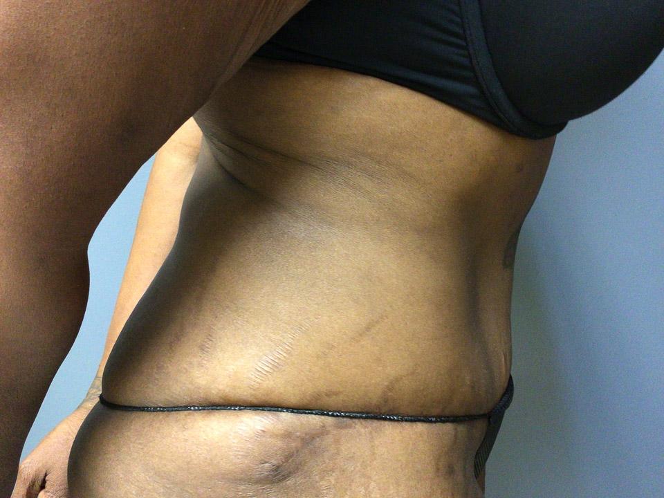 Aesthetic Plastic Surgery & Laser Center, Michelle Hardaway M.D. tummy tuck after — Farmington Hills, MI