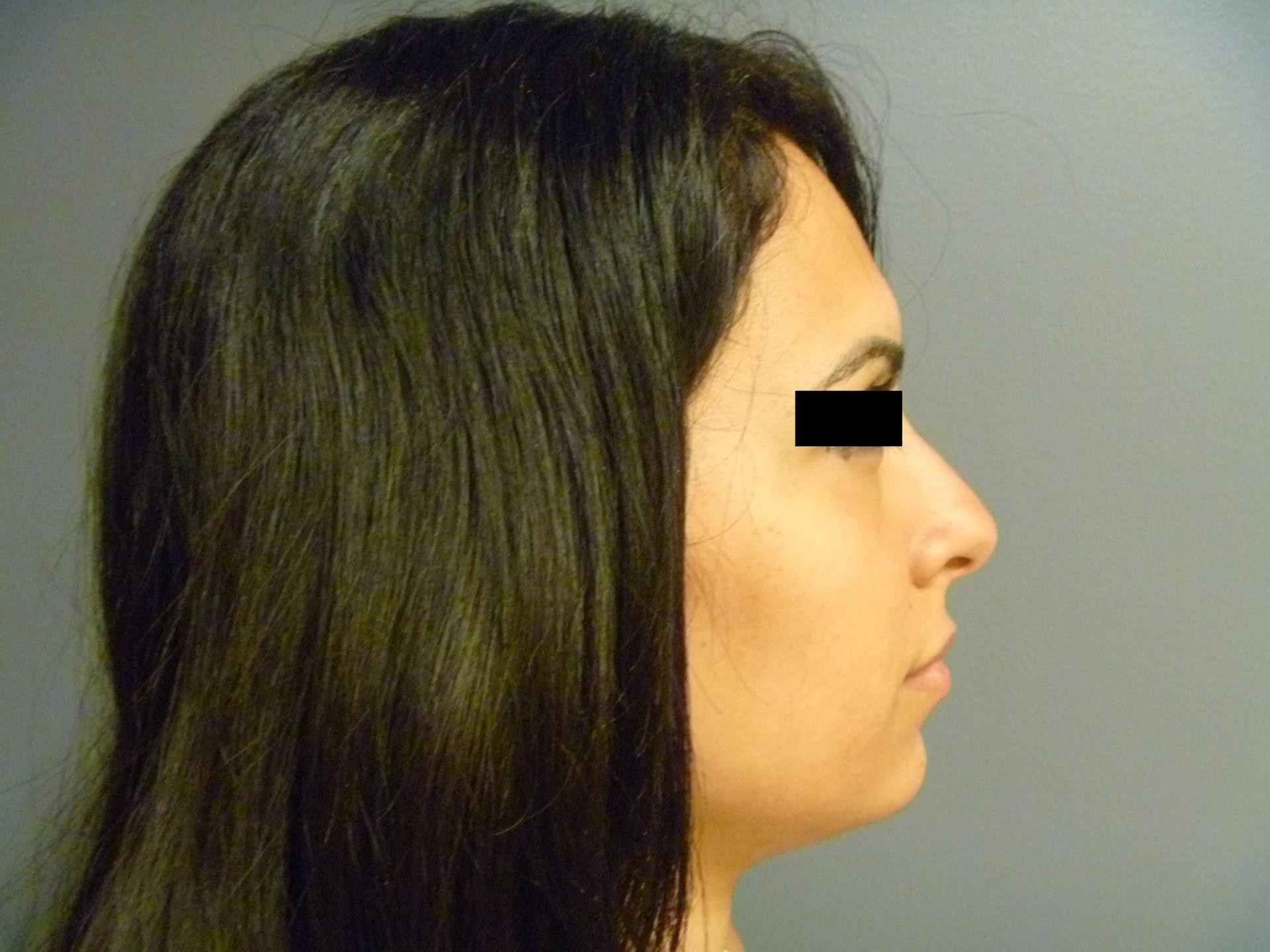 Aesthetic Plastic Surgery & Laser Center, Michelle Hardaway M.D. rhinoplasty after — Farmington Hills, MI