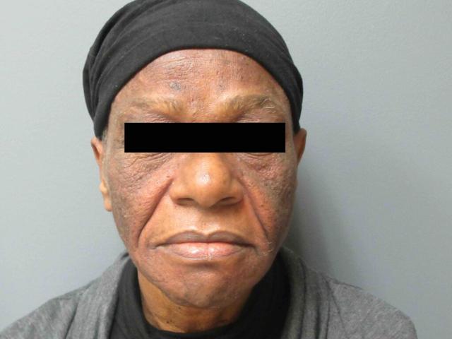 Morpheus8 before at Aesthetic Plastic Surgery & Laser Center, Michelle Hardaway M.D. in Farmington Hills, MI