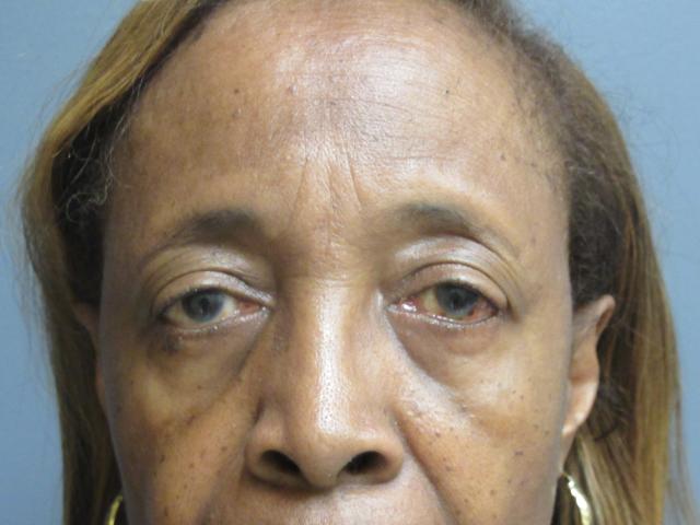Brow Lift before at Aesthetic Plastic Surgery & Laser Center, Michelle Hardaway M.D. in Farmington Hills, MI