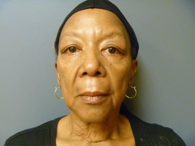 Mini Facelift before at Aesthetic Plastic Surgery & Laser Center, Michelle Hardaway M.D. in Farmington Hills, MI