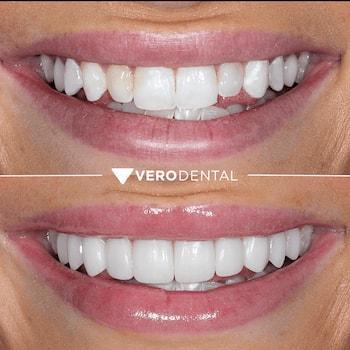 Vero Dental veneers result — Lehi, UT