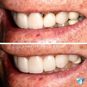 Vero Dental veneers result — Lehi, UT