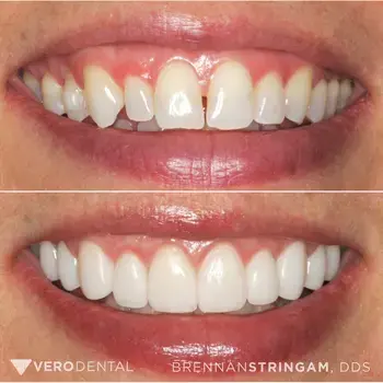 Vero Dental veneers result — Lehi, UT