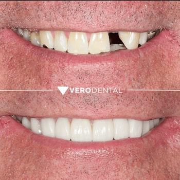 Vero Dental smile makeover result — Lehi, UT