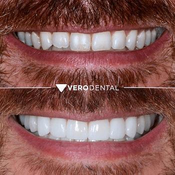 Vero Dental veneers result — Lehi, UT