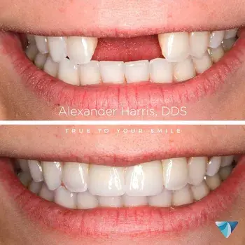 Dental Implants result at Vero Dental in Lehi, UT