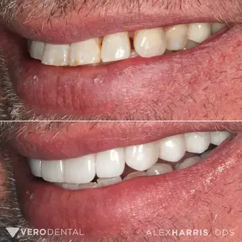 Dental Crowns result at Vero Dental in Lehi, UT