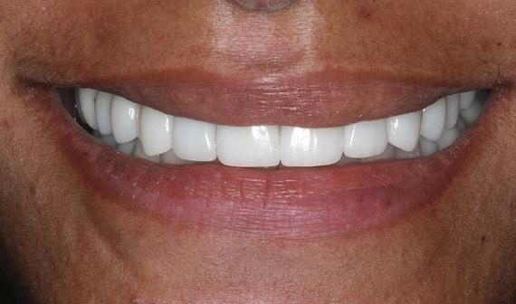 Smile Makeover after at Vero Dental in Lehi, UT