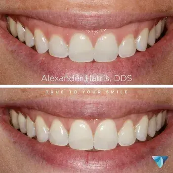 Gum Contouring result at Vero Dental in Lehi, UT