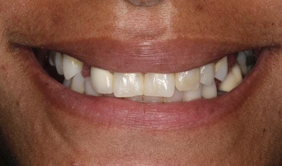 Smile Makeover before at Vero Dental in Lehi, UT