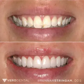 Vero Dental veneers result — Lehi, UT