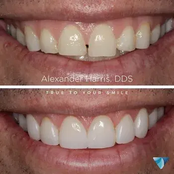 Vero Dental veneers result — Lehi, UT