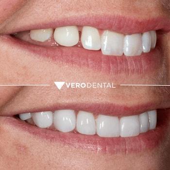 Vero Dental veneers result — Lehi, UT