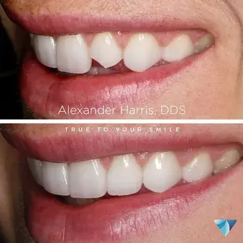 Dental Veneers result at Vero Dental in Lehi, UT