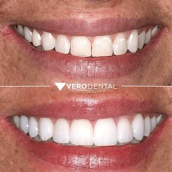 Vero Dental veneers result — Lehi, UT